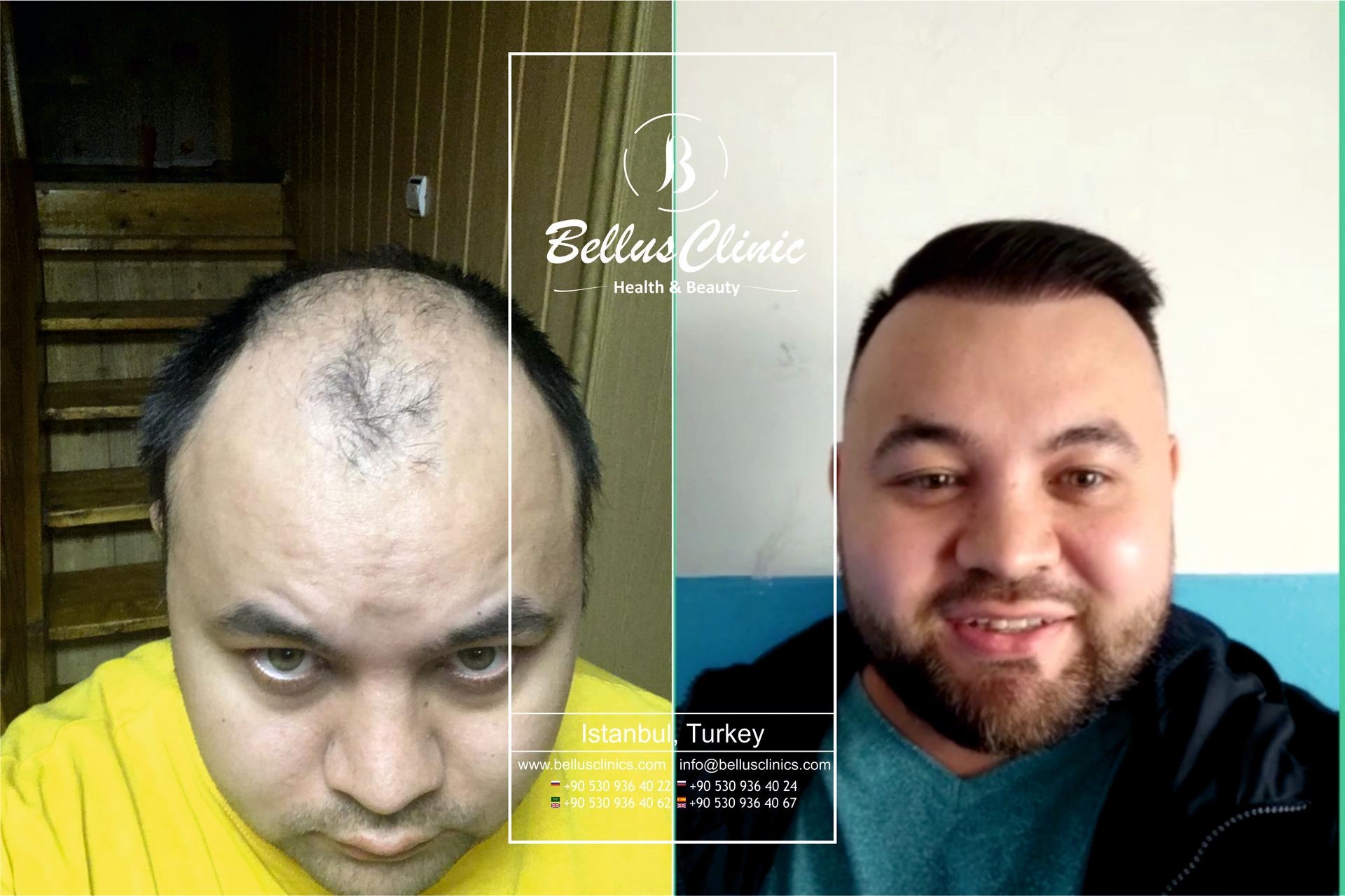 large baldness after hair transplant
