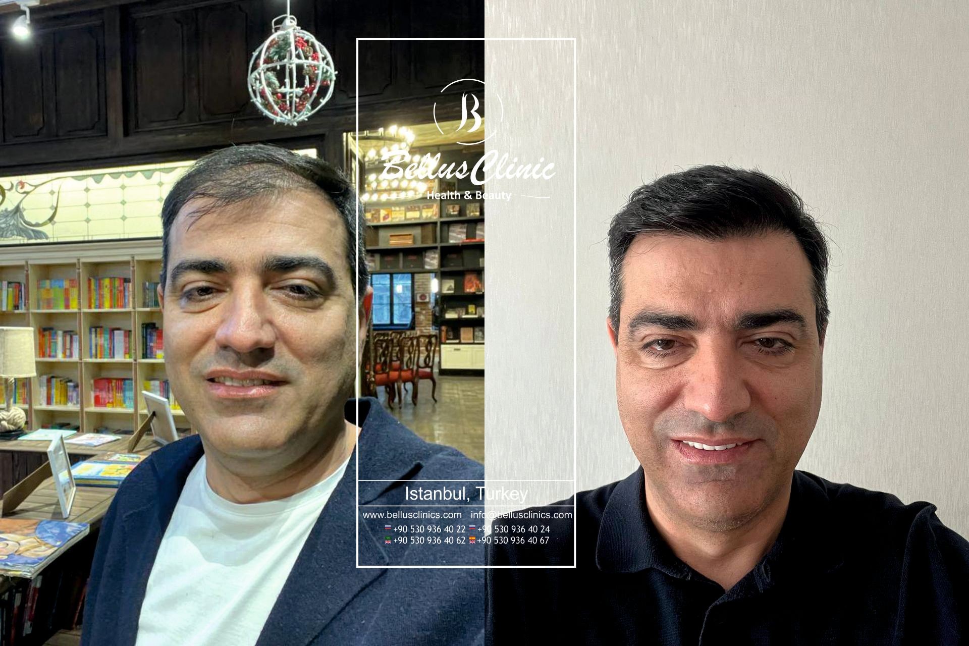 Hair transformation hair transplant before and after